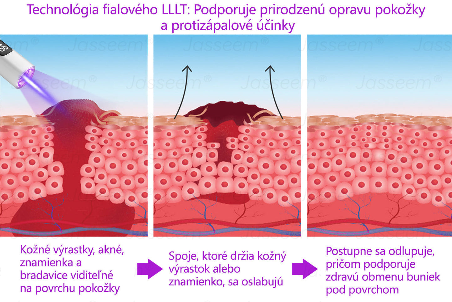 🟢𝐉𝐚𝐬𝐬𝐞𝐞𝐦® Pokročilé neinvazívne CO₂ laserové pero na opravu pokožky 💕 (Jemne odstraňuje bradavice, materské znamienka, starecké škvrny a kožné výrastky – bez bolesti, bez starostí!)