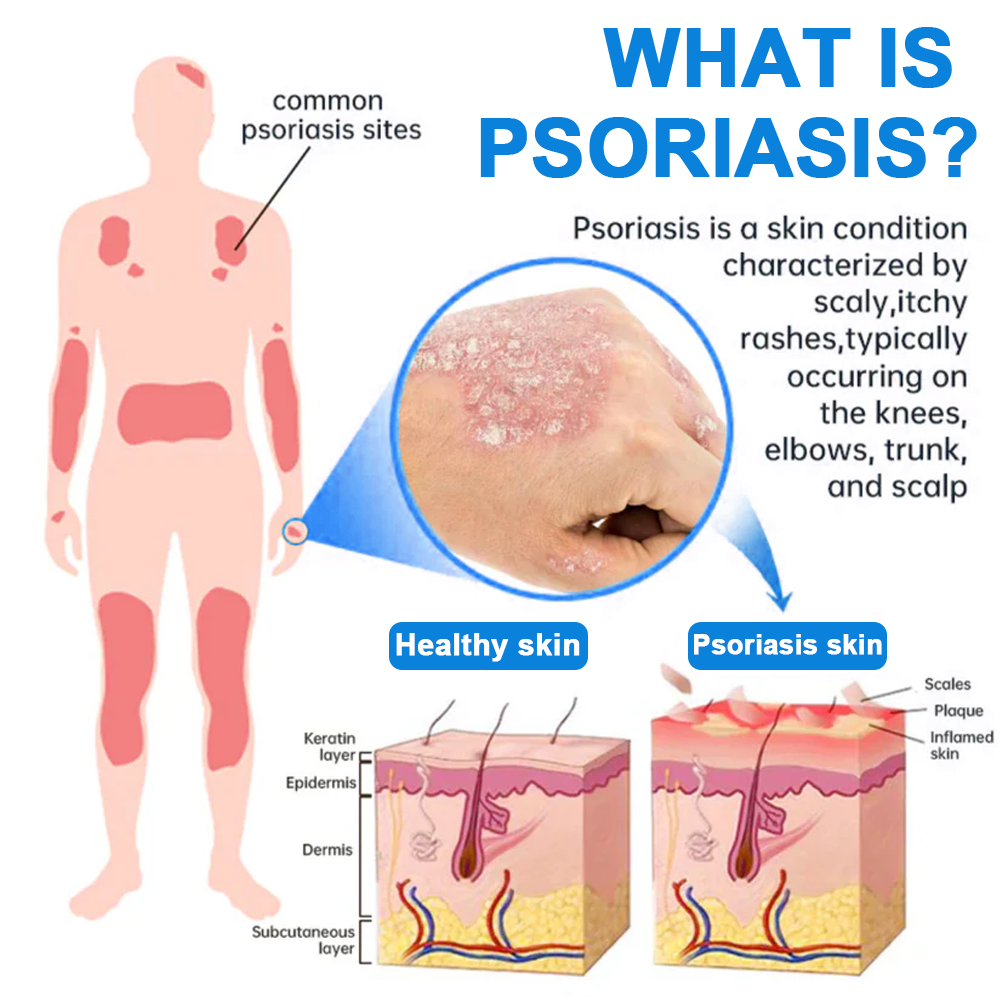 Službena trgovina: Zvoevo® 👾 Magnezijev biljni sprej protiv psorijaze — Odobreno od strane FDA (Ublažava psorijazu i ekcem, poboljšava bakterijske infekcije u području genitalija, liječi rozaceu i hidradenitis suppurativu, te akne i bradavice
