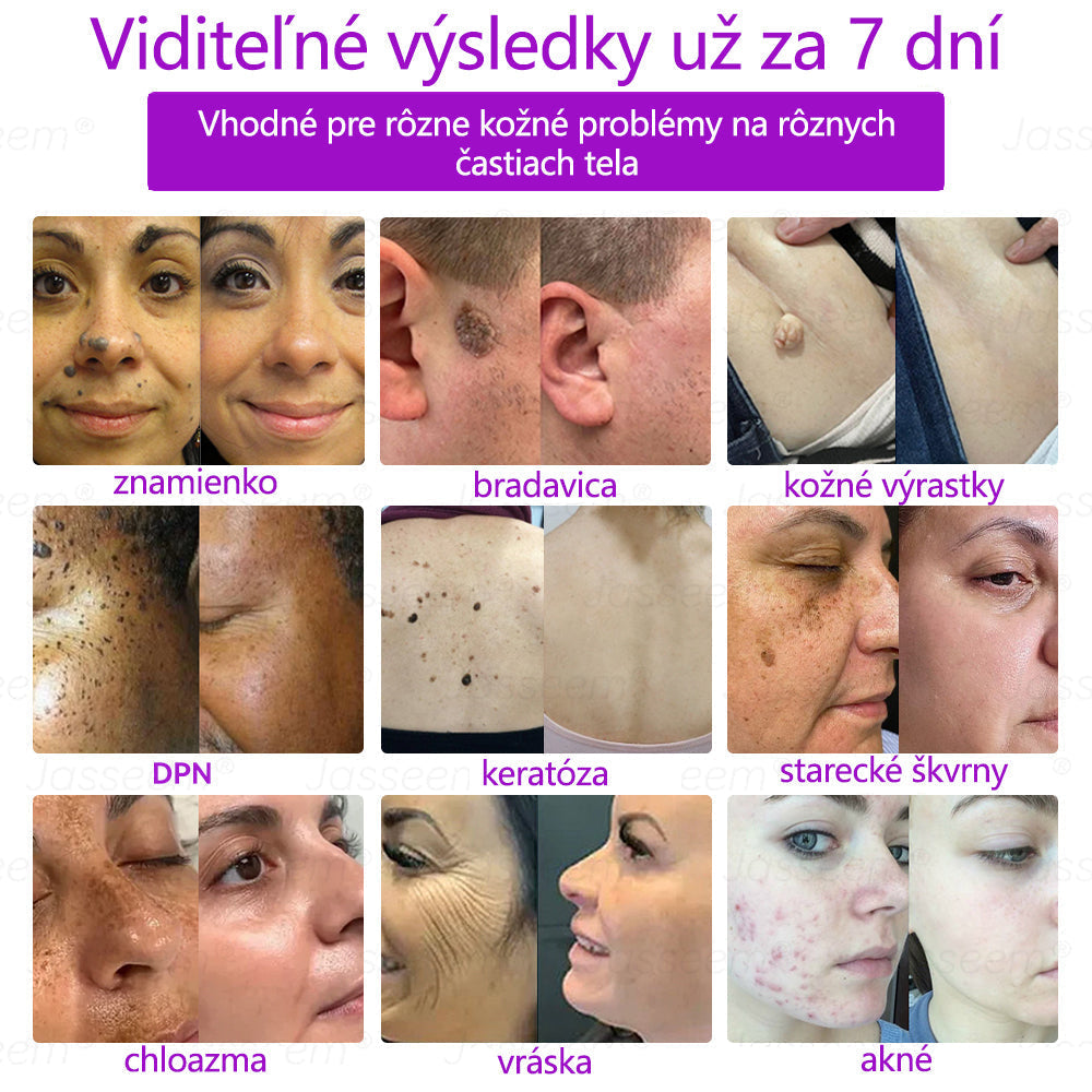 🟢𝐉𝐚𝐬𝐬𝐞𝐞𝐦® Pokročilé neinvazívne CO₂ laserové pero na opravu pokožky 💕 (Jemne odstraňuje bradavice, materské znamienka, starecké škvrny a kožné výrastky – bez bolesti, bez starostí!)