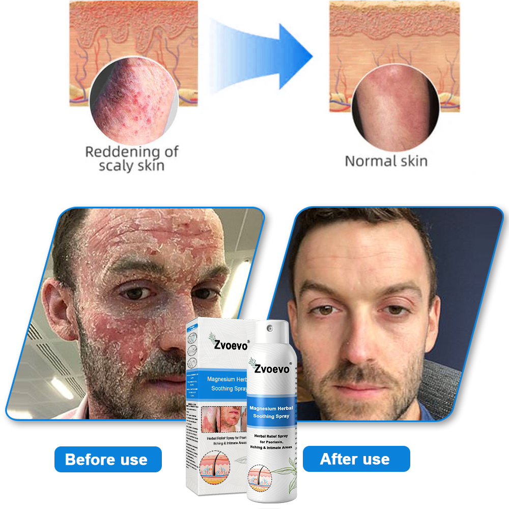 Službena trgovina: Zvoevo® 👾 Magnezijev biljni sprej protiv psorijaze — Odobreno od strane FDA (Ublažava psorijazu i ekcem, poboljšava bakterijske infekcije u području genitalija, liječi rozaceu i hidradenitis suppurativu, te akne i bradavice