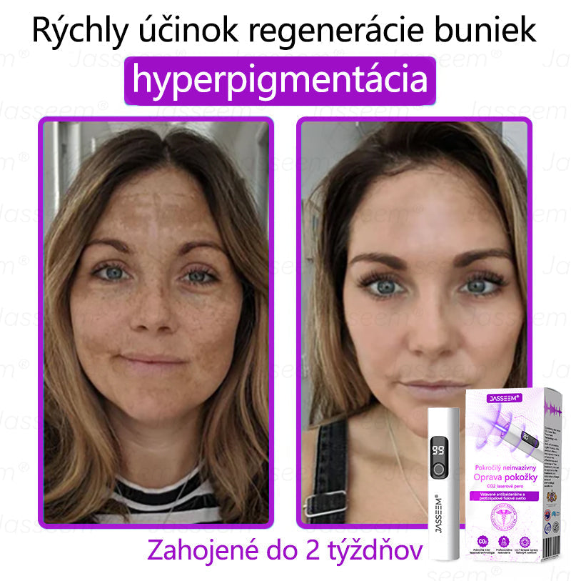 🟢𝐉𝐚𝐬𝐬𝐞𝐞𝐦® Pokročilé neinvazívne CO₂ laserové pero na opravu pokožky 💕 (Jemne odstraňuje bradavice, materské znamienka, starecké škvrny a kožné výrastky – bez bolesti, bez starostí!)