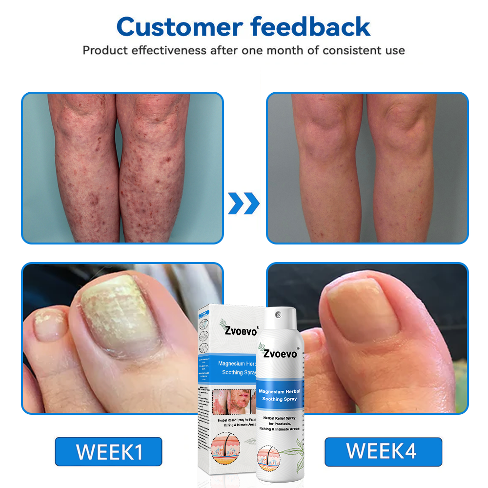 Službena trgovina: Zvoevo® 👾 Magnezijev biljni sprej protiv psorijaze — Odobreno od strane FDA (Ublažava psorijazu i ekcem, poboljšava bakterijske infekcije u području genitalija, liječi rozaceu i hidradenitis suppurativu, te akne i bradavice