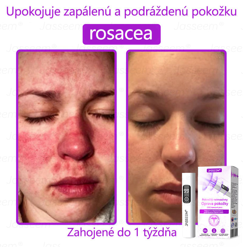 🟢𝐉𝐚𝐬𝐬𝐞𝐞𝐦® Pokročilé neinvazívne CO₂ laserové pero na opravu pokožky 💕 (Jemne odstraňuje bradavice, materské znamienka, starecké škvrny a kožné výrastky – bez bolesti, bez starostí!)