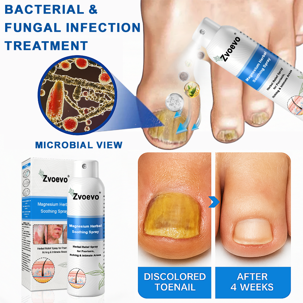 Službena trgovina: Zvoevo® 👾 Magnezijev biljni sprej protiv psorijaze — Odobreno od strane FDA (Ublažava psorijazu i ekcem, poboljšava bakterijske infekcije u području genitalija, liječi rozaceu i hidradenitis suppurativu, te akne i bradavice