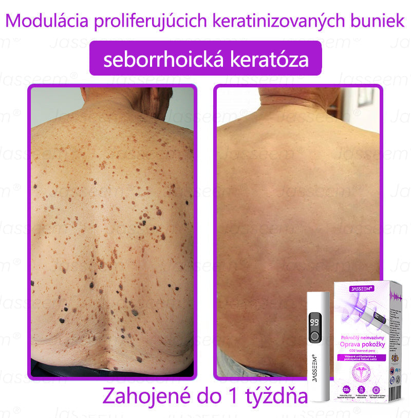 🟢𝐉𝐚𝐬𝐬𝐞𝐞𝐦® Pokročilé neinvazívne CO₂ laserové pero na opravu pokožky 💕 (Jemne odstraňuje bradavice, materské znamienka, starecké škvrny a kožné výrastky – bez bolesti, bez starostí!)