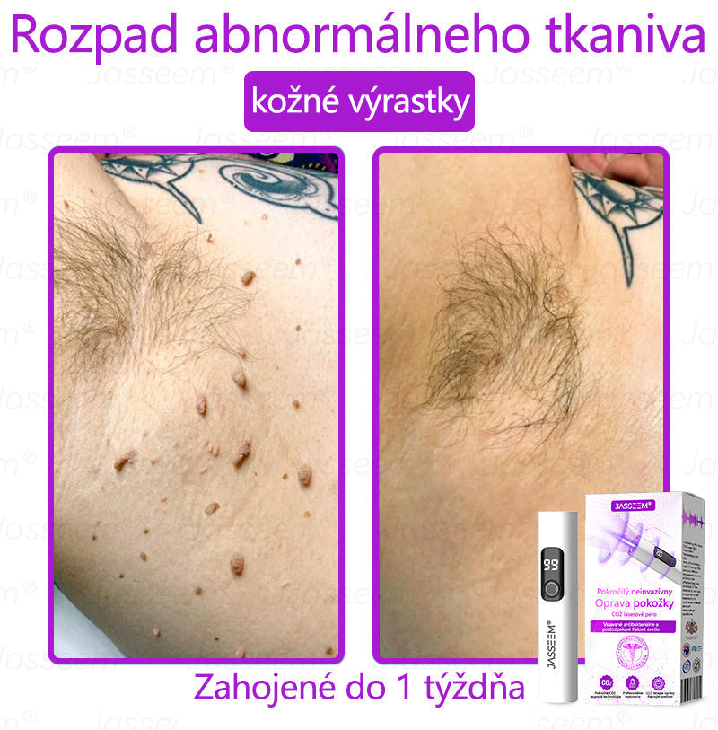 🟢𝐉𝐚𝐬𝐬𝐞𝐞𝐦® Pokročilé neinvazívne CO₂ laserové pero na opravu pokožky 💕 (Jemne odstraňuje bradavice, materské znamienka, starecké škvrny a kožné výrastky – bez bolesti, bez starostí!)