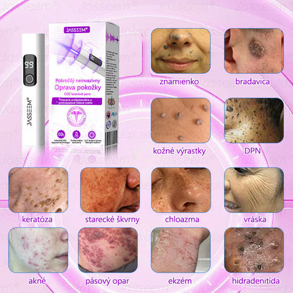 🟢𝐉𝐚𝐬𝐬𝐞𝐞𝐦® Pokročilé neinvazívne CO₂ laserové pero na opravu pokožky 💕 (Jemne odstraňuje bradavice, materské znamienka, starecké škvrny a kožné výrastky – bez bolesti, bez starostí!)