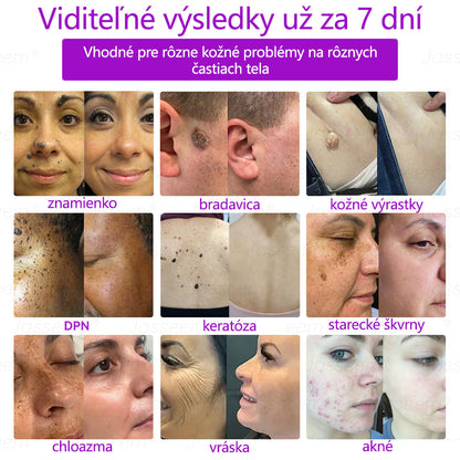 🟢𝐉𝐚𝐬𝐬𝐞𝐞𝐦® Pokročilé neinvazívne CO₂ laserové pero na opravu pokožky 💕 (Jemne odstraňuje bradavice, materské znamienka, starecké škvrny a kožné výrastky – bez bolesti, bez starostí!)