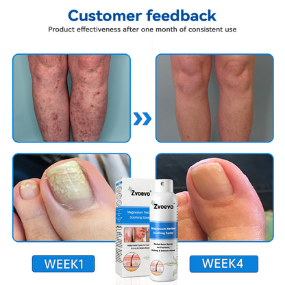 Službena trgovina: Zvoevo® 👾 Magnezijev biljni sprej protiv psorijaze — Odobreno od strane FDA (Ublažava psorijazu i ekcem, poboljšava bakterijske infekcije u području genitalija, liječi rozaceu i hidradenitis suppurativu, te akne i bradavice